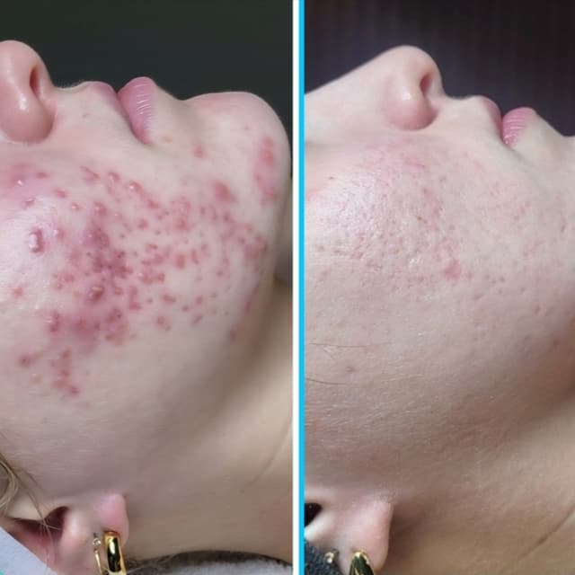 Skin Rejuvenation Series (5) at Glowasis in Hoboken, NJ